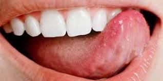 Dilde Çıkan Uçuk Nasıl Geçer?