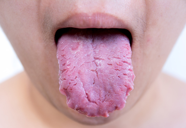 İyi Huylu Dil Tümörü