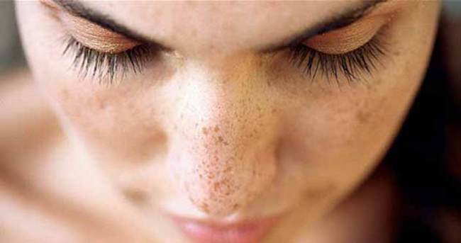 Yüzde Pembe Lekeler